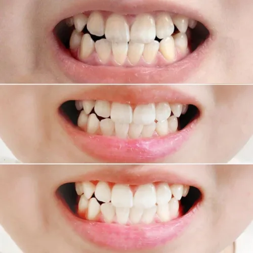 Nguồn hàng sỉ kem Đánh Răng Median Màu Đỏ Dental IQ 93% Tartar Toothpaste Badbreath 120g