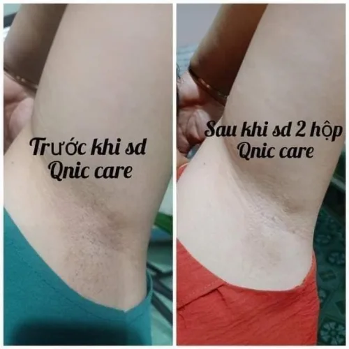 Nơi lấy sỉ kem Giảm Thâm Nách Q Nic Care Thái Lan Phiên Bản Mới