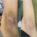 Nơi lấy sỉ kem Giảm Thâm Nách Q Nic Care Thái Lan Phiên Bản Mới