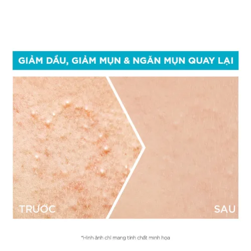 Nơi lấy sỉ serum Garnier Giảm Mụn Sáng Da Skin Naturals Bright Complete Anti-Acne Booster Serum 30ml