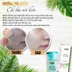 Serum giảm mụn Jiuhe Acne Extra 5ml của Thanh Tô Cosmetics