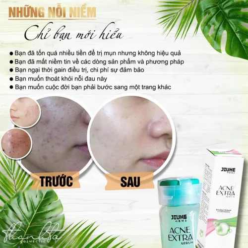 Serum giảm mụn Jiuhe Acne Extra 5ml của Thanh Tô Cosmetics