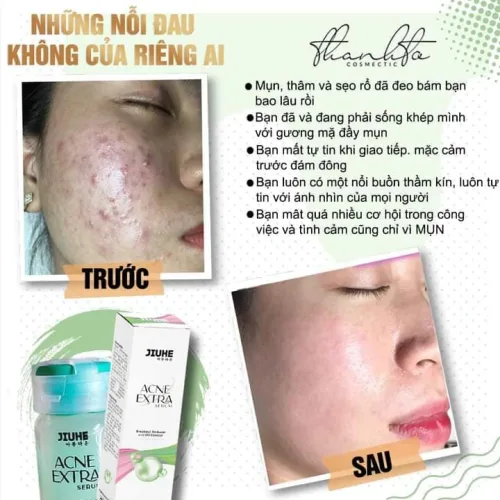 Serum giảm mụn Jiuhe Acne Extra 5ml của Thanh Tô Cosmetics