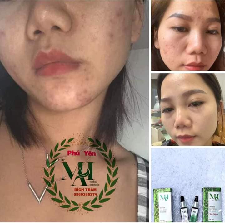 DR MAI KHẮC TINH CỦA CÁC LOẠI MỤN