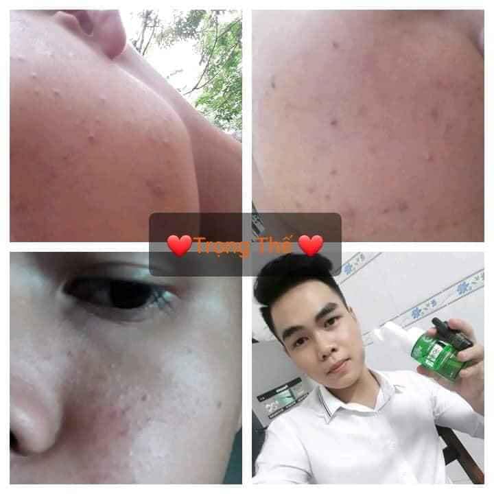 DR MAI KHẮC TINH CỦA CÁC LOẠI MỤN