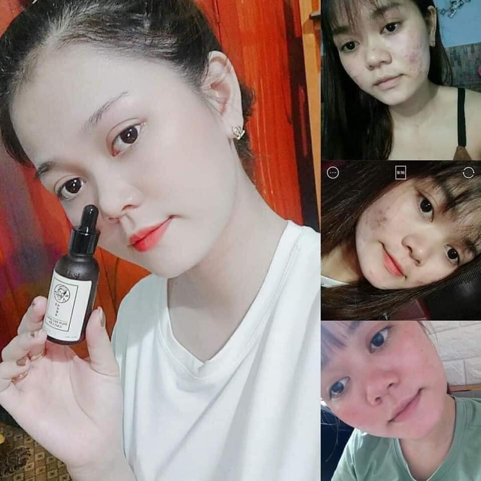TRỊ MỤN BÀ LÃO - sản phẩm thảo dược thiên nhiên