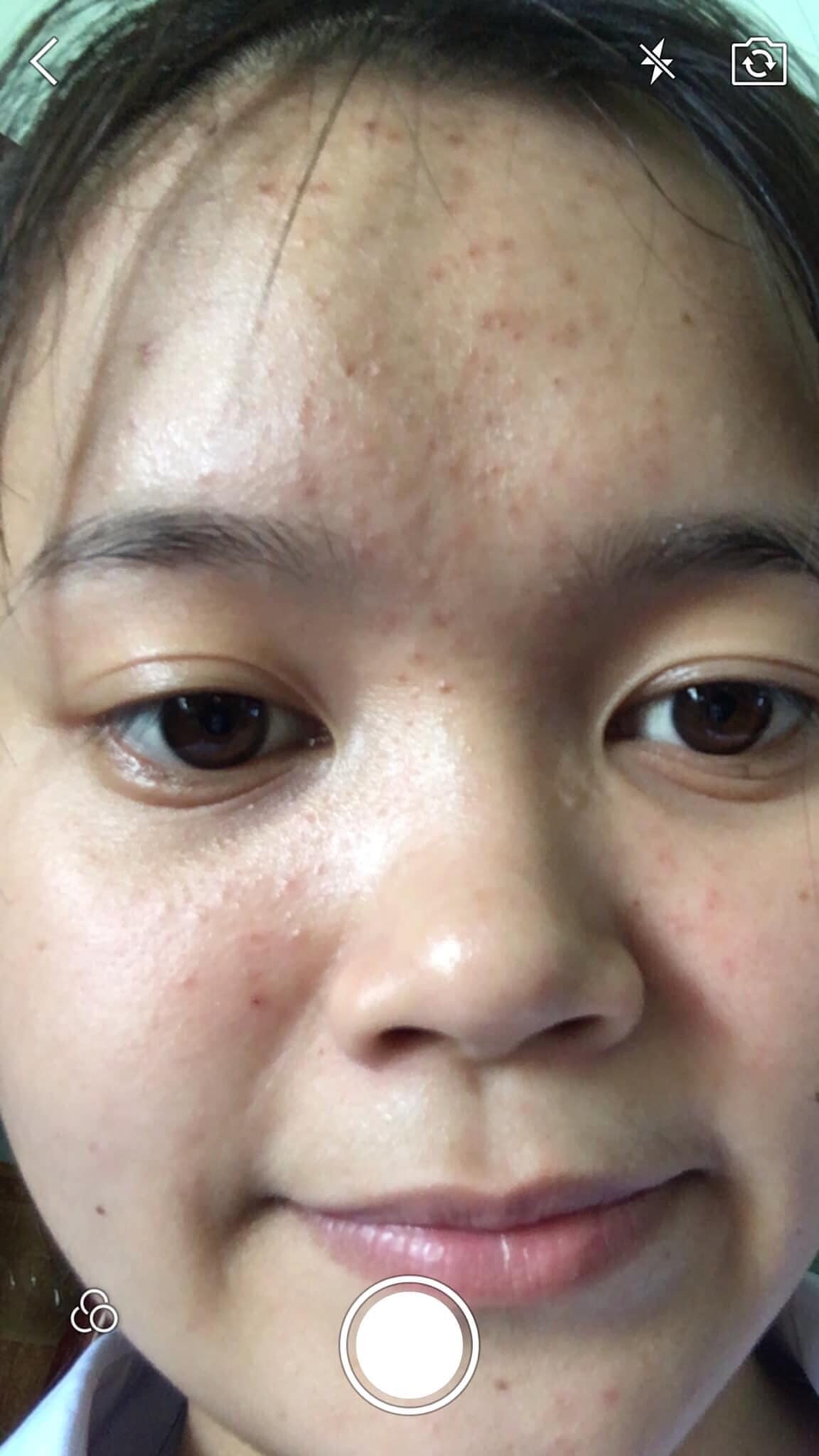 Phụ nữ muốn đẹp phải siêng, đừng lười biếng để mặt đầy mụn