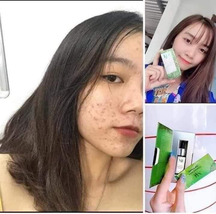 Trị mụn DR Mai vừa hợp túi tiền - vừa an toàn hiệu quả