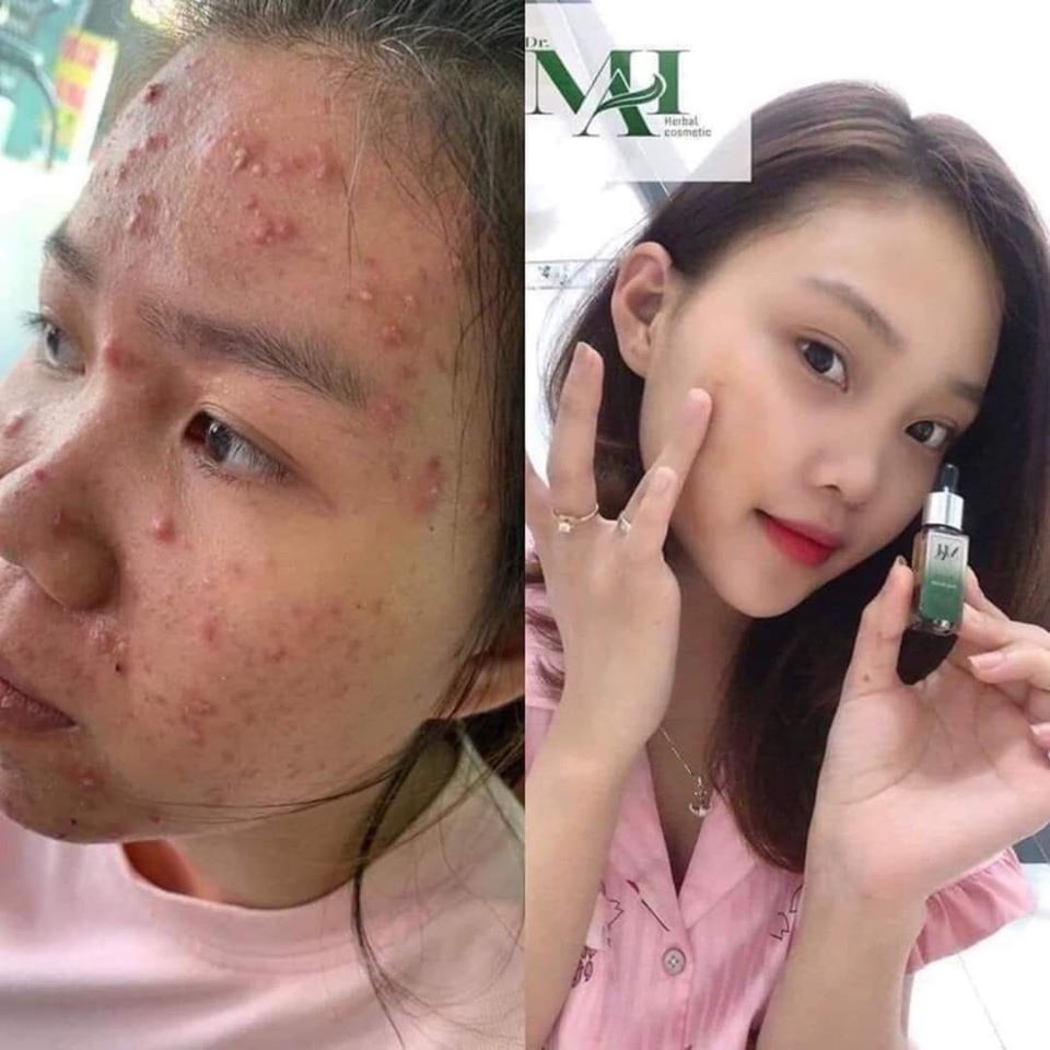 Trị mụn với DR Mai để cảm nhận hiệu quả nhanh chóng