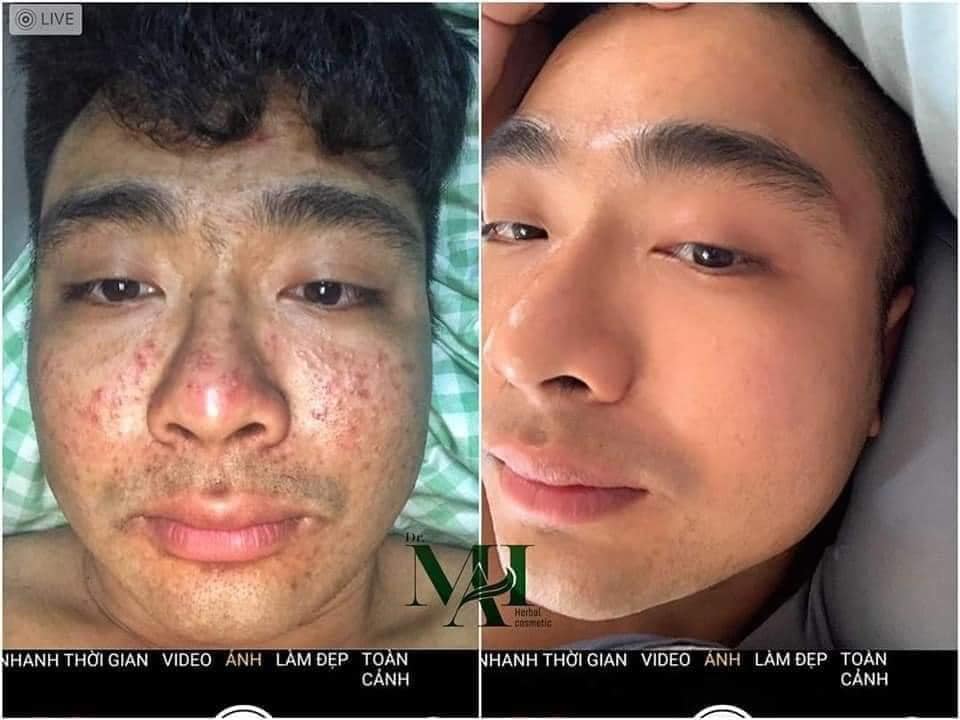 DR MAI trị mụn cho nam