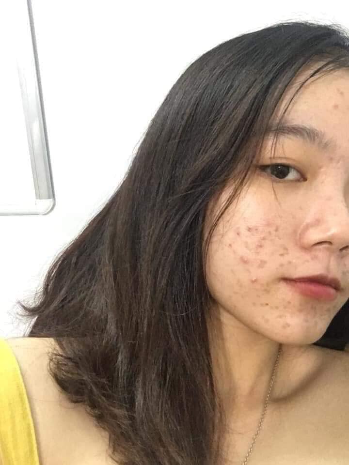 Điều trị mụn giờ đây trở nên đơn giản và tiết kiệm nhất chỉ với 230k