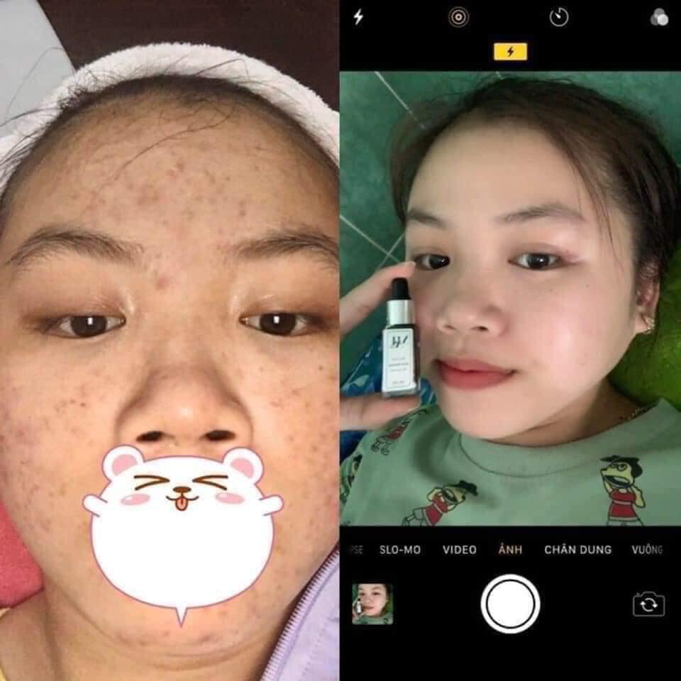 4 lý do - bất kỳ ai cũng cần 1 lọ Dr Mai trị mụn cho riêng mình