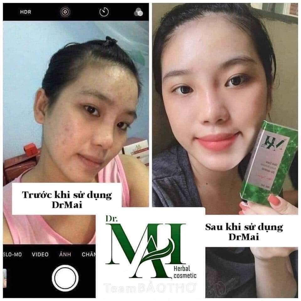 4 lý do - bất kỳ ai cũng cần 1 lọ Dr Mai trị mụn cho riêng mình