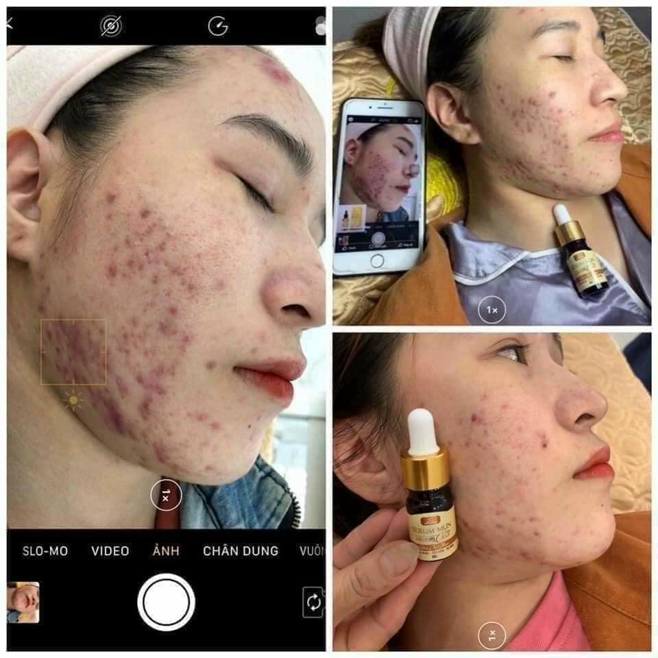 serum trị mụn x3 với tinh chất chiếc xuất từ thiên nhiên